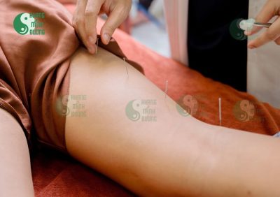 Châm cứu nên kết hợp với những phương pháp nào để đạt hiệu quả tốt hơn?