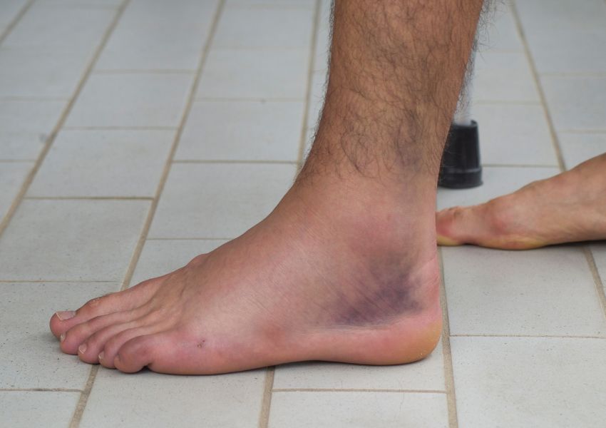 Những điều không nên làm khi bị bong gân
